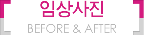 임상 전후사진