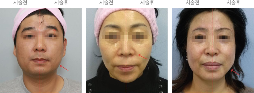 전후사진