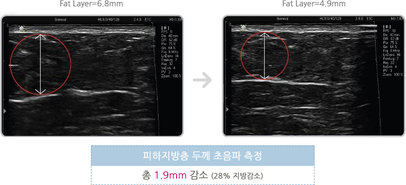 미쿨전후사진