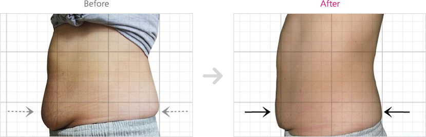 미쿨전후사진