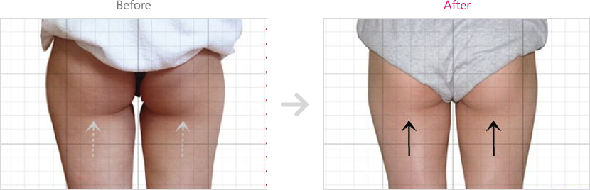 미쿨전후사진